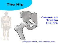 Causes and Medical Treatment of Hip Fractures