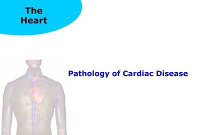 Pathology of Cardiac Disease (Screencast)